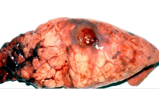 Lesiones de App crónica en el lóbulo diafragmático con acúmulos de fibrina.