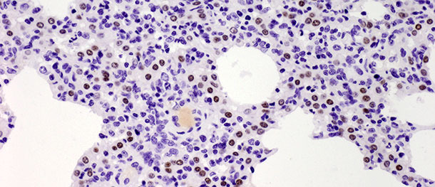 Los puntos marrones indican el núcelo de los neumocitos tipo II identificados con anticuerpos anti-TTF-1. Se observó un aumento significativo en el número de células positivas a los 10 días tras la infección con un aislado tipo I subtipo 1