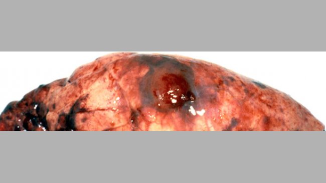 Lesión típica de Acpp – la lesión pulmonar hemorrágica y necrótica está cubierta por una adherencia pleural.