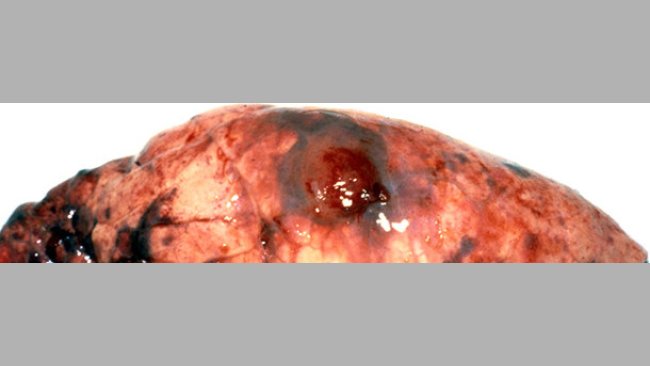 Lesión típica de Acpp – la lesión pulmonar hemorrágica y necrótica está cubierta por una adherencia pleural.