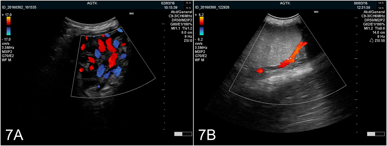 <p>Figura 7:Im&aacute;genes del test&iacute;culo&nbsp;obtenidas mediante ultrasonograf&iacute;a&nbsp;Doppler color. A) Vasos del cord&oacute;n esperm&aacute;tico. B) Arteria testicularis</p>
