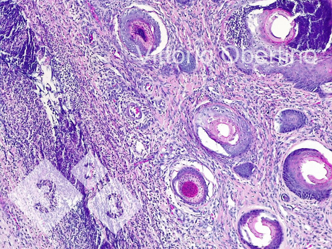 Figura 8. Ombligo. &Aacute;rea d&eacute;rmica localmente extendida que consta de fibroplasia con fibroblastos activados y numerosos vasos peque&ntilde;os inmaduros (tejido de granulaci&oacute;n reci&eacute;n formado), infiltrado inflamatorio multifocal con predominio de c&eacute;lulas linfoplasmacelulares; en algunas estructuras vasculares existe un infiltrado inflamatorio granuloc&iacute;tico que rodea la pared del vaso y la infiltra focalmente (vasculitis leucotariana).
