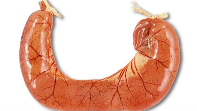 A necropsia dos casos de diarreia por ETEC geralmente mostra alças intestinais dilatadas, delgadas e congestionadas, cheias de diarreia aquosa amarela.