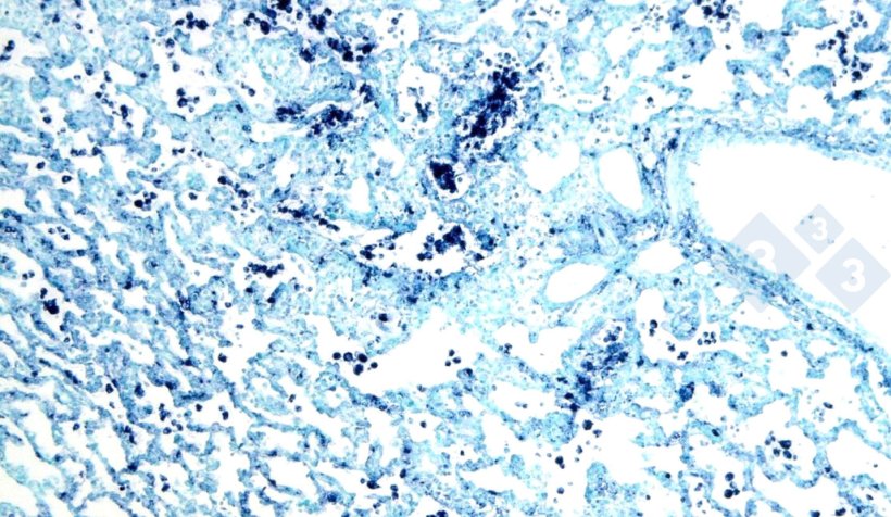 Figura 4. Hibridiza&ccedil;&atilde;o in situ para detec&ccedil;&atilde;o de circov&iacute;rus su&iacute;no 2 (PCV2) em pulm&atilde;o afetado por pneumonia intersticial.
