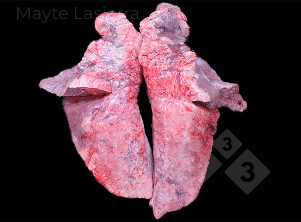 Processo broncopneum&ocirc;nico
