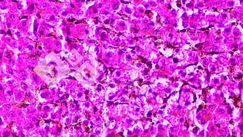 Figure 4. Focal hepatic necrosis with occasional amphophilic intranuclear inclusions in peri-necrotic zone. Liver.
