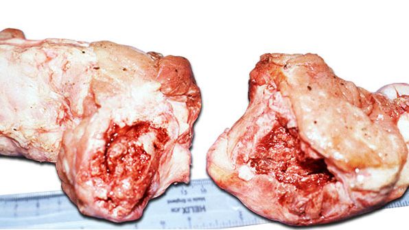 Ganzer Oberschenkelkopf am oder unter dem Knochenende gebrochen, mit Schwellungen um die Frakturstelle aufgrund einer Knochenhautentz&uuml;ndung.