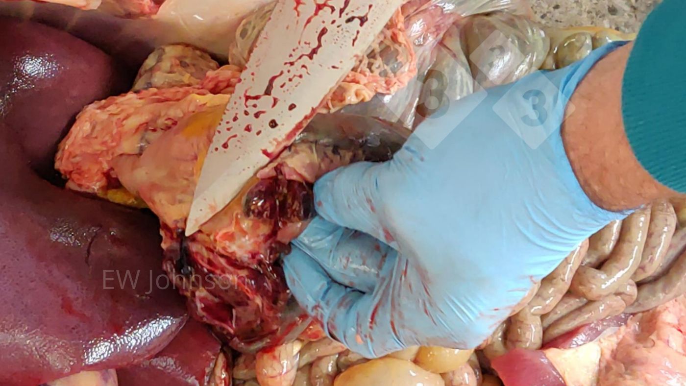 Foto 2: Blutungen und Nekrosen in gastrohepatischem Lymphknoten
