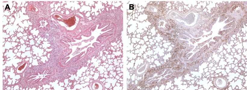 Figura 3. Polmone di suino co-infettato da M. hyopneumoniae e PCV2. A: Area di iperplasia linfoide peri-bronchiolare causata da M. hyopneumoniae. B: Gran quantità di antigene da PCV2 nella stessa area di iperplasia linfoide.