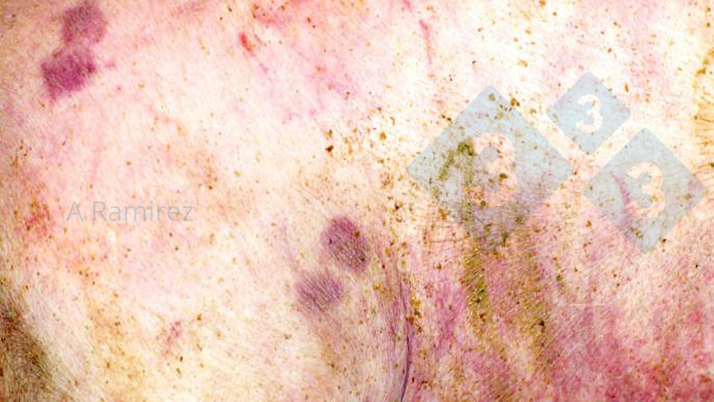 Figura 1. Lesione cutanea a forma di diamante quasi patognomonica.
