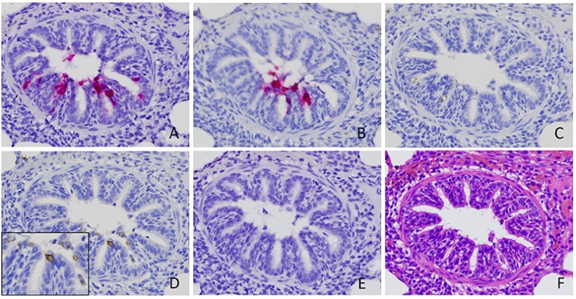Figura 2. Identificazione di rotavirus A (RVA) nelle cellule epiteliali bronchiolari. Il segnale positivo dell'acido nucleico RVA è stato rilevato mediante ibridazione in situ (ISH) utilizzando una sonda mirata a VP6 (A) e NSP3 (B). Segnali positivi di colorazione immunoistochimica utilizzando anticorpi contro RVA VP6 (C) e dsRNA (D), sebbene più deboli, sono stati rilevati anche nelle sezioni seriali ottenute dallo stesso caso. Nessun segnale è stato rilevato da ISH utilizzando una sonda mirata al rotavirus B (E) (18). È stata eseguita una sezione seriale con colorazione di routine con ematossilina ed eosina (F). Le immagini sono state scattate con un ingrandimento di 400x.