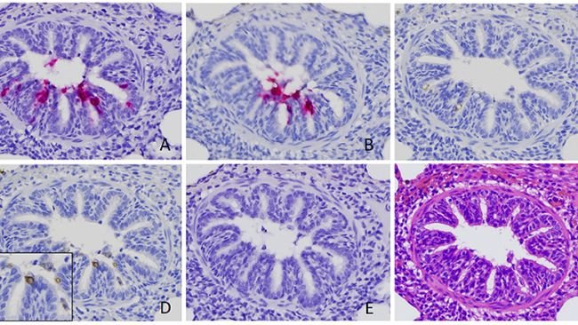 Figura 2. Identificazione di rotavirus A (RVA) nelle cellule epiteliali bronchiolari. Il segnale positivo dell'acido nucleico RVA è stato rilevato mediante ibridazione in situ (ISH) utilizzando una sonda mirata a VP6 (A) e NSP3 (B). Segnali positivi di colorazione immunoistochimica utilizzando anticorpi contro RVA VP6 (C) e dsRNA (D), sebbene più deboli, sono stati rilevati anche nelle sezioni seriali ottenute dallo stesso caso. Nessun segnale è stato rilevato da ISH utilizzando una sonda mirata al rotavirus B (E) (18). È stata eseguita una sezione seriale con colorazione di routine con ematossilina ed eosina (F). Le immagini sono state scattate con un ingrandimento di 400x.