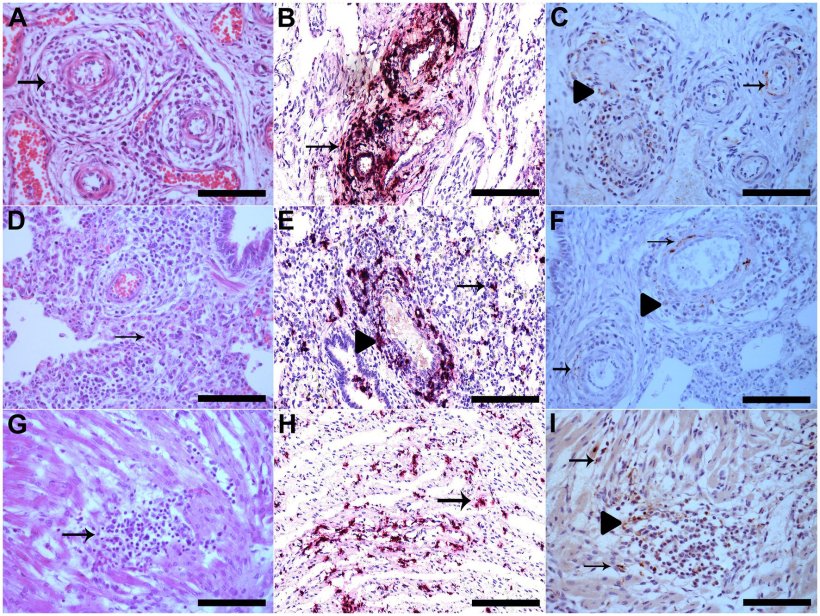 Figura 1. (A) Le pareti dei vasi del plesso mesenterico sono interrotte da una marcata infiltrazione di linfociti, istiociti e plasmacellule, oltre alla degenerazione fibrinoide (freccia), HE, Bar. 120&thinsp;&mu;m. (B) Plesso mesenterico vascolare con colorazione PCV3 nelle cellule infiammatorie e nelle pareti dei vasi che &egrave; mostrato in rosso (freccia), l'ematossilina &egrave; stata utilizzata come colorante di contrasto per tingere la sezione tissutale per ISH Bar. 120&thinsp;&mu;m. (C) Plesso mesenterico vascolare con immunomarcatura PCV3 nel citoplasma delle cellule infiammatorie nelle aree perivascolari (punta di freccia) e nel citoplasma e nel nucleo delle cellule della muscolatura liscia delle arterie (freccia), IHQ, AEC, Bar. 120&thinsp;&mu;m. (D) Polmone con setti alveolari diffusamente dilatati da linfociti e macrofagi (polmonite interstiziale) (freccia), HE, Bar. 120&thinsp;&mu;m. (E) Polmone con colorazione multifocale di PCV3 nelle cellule infiammatorie nelle aree interstiziali (freccia) e nelle aree perivascolari, che &egrave; mostrato in rosso (punta di freccia), ISH, Bar. 120&thinsp;&mu;m. (F) Polmone con immunomarcatura PCV3 nel citoplasma delle cellule infiammatorie nelle aree perivascolari (punta di freccia) e nel citoplasma e nel nucleo delle cellule della muscolatura liscia delle arterie (freccia), IHQ, AEC, Bar. 120&thinsp;&mu;m. (G) area di lieve miocardite linfoistiocitica (freccia), HE, Bar. 120&thinsp;&mu;m. (H) Cardiomiociti con colorazione PCV3 multifocale, mostrata in rosso (freccia), ISH, Bar. 120&thinsp;&mu;m. (I) Cuore con immunomarcatura PCV3 nel citoplasma delle cellule infiammatorie (punta di freccia) e nel citoplasma dei cardiomiociti (freccia), IHQ, AEC, Bar. 120&thinsp;&mu;m.
Ulteriori informazioni su questo testo di originePer avere ulteriori informazioni sulla traduzione &egrave; necessario il testo di origine
Invia commenti
Riquadri laterali