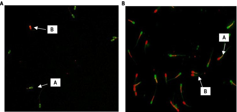 Figura 1. (A) Gli spermatozoi con la freccia &ldquo;A&rdquo; che emettono fluorescenza verde hanno DNA intatto, mentre quelli con fluorescenza da arancione a rossa sono spermatozoi con DNA danneggiato (400X). (B) Gli spermatozoi con la freccia "A" che emettono fluorescenza rossa nella regione centrale indicano MMP elevati, mentre quelli con fluorescenza verde sono spermatozoi con MMP bassi (400X).