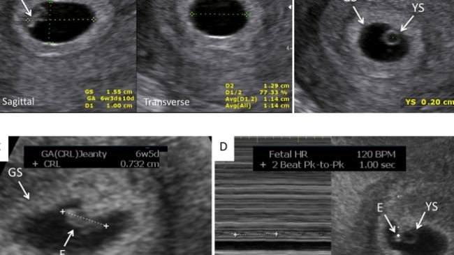Posizione corretta del cursore per la misurazione dei parametri oggetto di indagine: (A) Sacco embrionale (GS); (B). Sacco vitellinico (YS); (C). Lunghezza Testa-groppa (CRL); (D). Frequenza cardiaca (FC). E = Embrione.