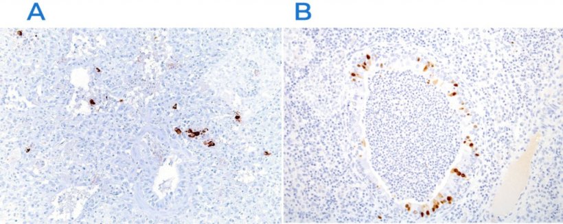 Figura 3. Immunoistochimica per rilevare il virus della sindrome riproduttiva e respiratoria suina (PRRSV) (A) e il virus dell'influenza suina (B). Nelle aree colpite si riscontra la presenza dell'antigene virale (colorazione marrone).
