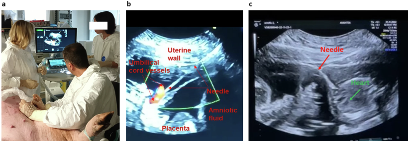 Innoculazione in utero dei feti della scrofa guidata dall'ecografia:a - Immagine rappresentativa dell'iniezione transaddominale. b - Immagine ecografica dell'iniezione di scAAV9-CAG-GFP nella vena ombelicale fetale. c - Immagine ecografica dell'iniezione intracardiaca di scAAV9-CAG-GFP.https://doi.org/10.1038/s41434-025-00551-8