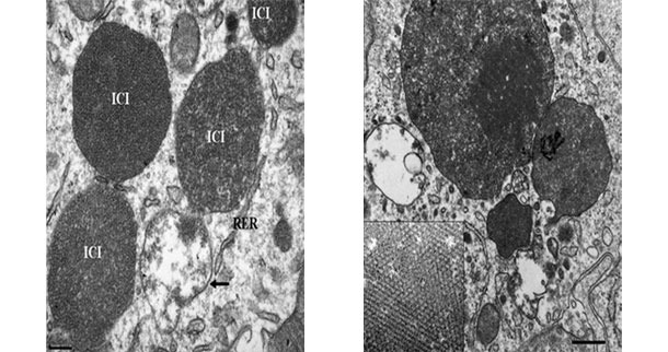 Microscop&iacute;a electr&oacute;nica de un ganglio linf&aacute;tico de un cerdo con PCV2-SD. N&oacute;tese la presencia de cuerpos de inclusi&oacute;n intracitoplasm&aacute;ticos con PCV2 (ICI); en algunas zonas, las part&iacute;culas virales pueden disponerse en estruturas paracristalinas  (recuadro de la imagen derecha)
