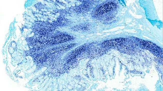 Íleon. El mismo íleon del cerdo afectado por enfermedad sistémica asociada a PCV2 presenta una gran cantidad de genoma de PCV2 en las placas de Peyer y en la mucosa intestinal. Hibridación in situ para detectar PCV2; colorante de contraste verde rápido.