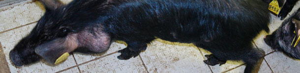 Melanoma e  metastasi nei linfonodi