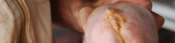 Diarrea neonatall causata da E. Coli (Cortesia Dr Hector Patullo)