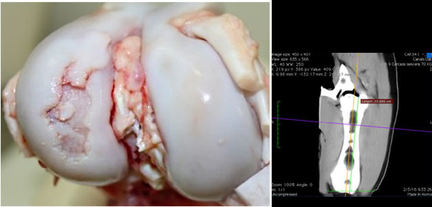 Visione macroscopica dell'articolazione del ginocchio con una grave lesione da osteocondrosi nel condilo laterale del femore.
