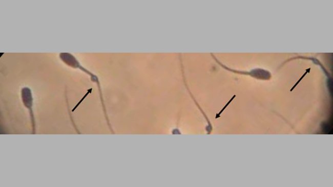 Anomalías del semen