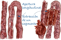 Toma de muestras de íleon