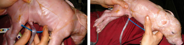 Cierre de ombligos con bridas