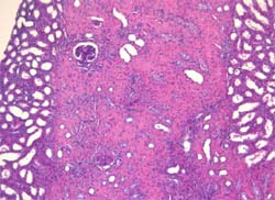 Fibrosis en el córtex renal