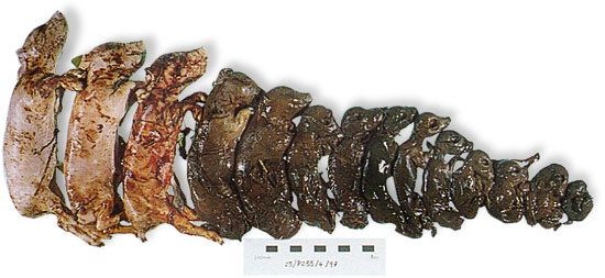 20100203_muerte_fetal_progresiva