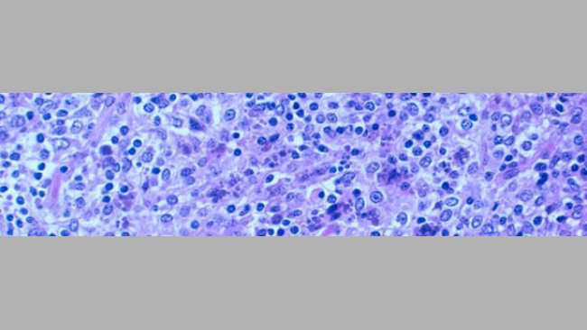 Depleción linfocitaria severa con inflamación granulomatosa del tejido linfoide. Presencia de cuerpos de inclusión intracitoplasmáticos.