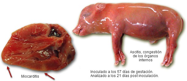 Miocarditis y ascitis