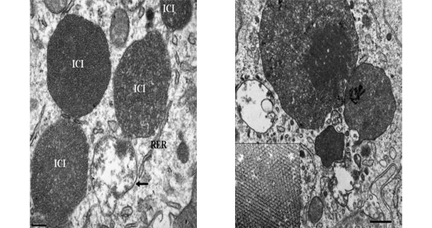 Microscopía electrónica de un linfonodo de un cerdo con PCV2-ES