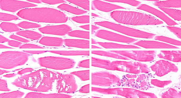 Diferentes etapas de degeneración/necrosis de miofibras
