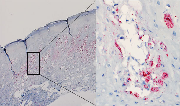 Biopsia cutánea de una vesícula de un cerdo afectado