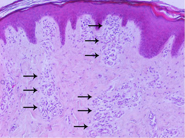 Análisis histopatológico de la piel: aumento de la vascularización principalmente en la dermis superficial y media