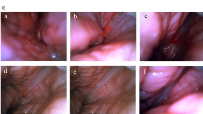 Inseminación post-cervical vista desde el interior del útero