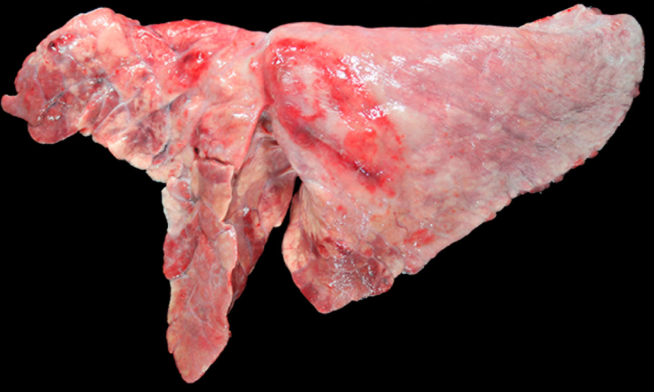 Figura 5: Pulm&oacute;n de un cerdo coinfectado con <em>M. hyopneumoniae</em> y <em>A. pleuropneumoniae</em>. &Aacute;reas de consolidaci&oacute;n craneoventrales de color marr&oacute;n-rojizo, provocada por la infecci&oacute;n por <em>M. hyopneumoniae</em>, y una lesi&oacute;n ovalada con fibrosis pleural y zonas hemorr&aacute;gicas en l&oacute;bulo diafragm&aacute;tico, que se corresponder&iacute;a a la cronicidad de un foco de necrosis producido por <em>A. pleuropneumoniae</em>.
