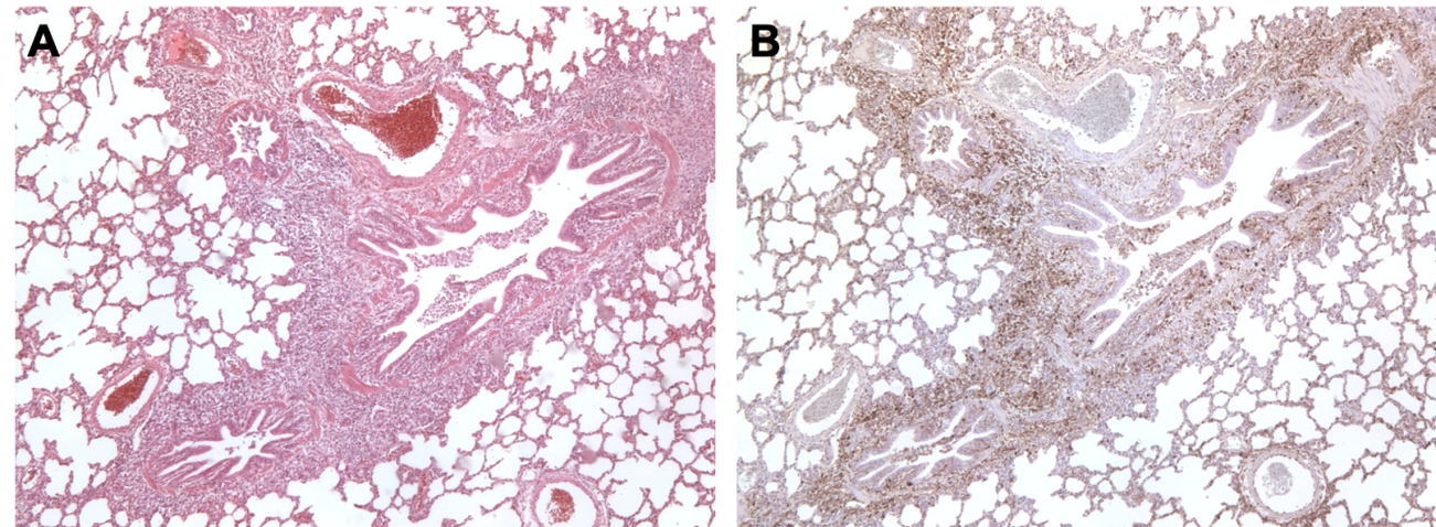 Figura 3. Pulm&oacute;n de un cerdo coinfectado por M. hyopneumoniae y PCV2. <strong>A:</strong> &Aacute;rea de hiperplasia linfoide peribronquiolar causada por M. hyopneumoniae. <strong>B:</strong> Gran cantidad de ant&iacute;geno de PCV2 en esa misma &aacute;rea de hiperplasia linfoide.
