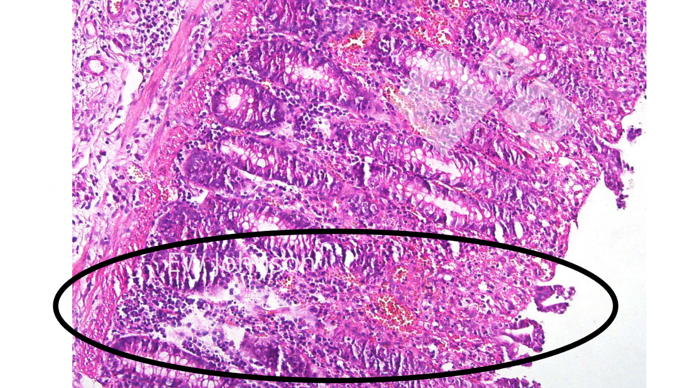 <p>Foto 4. Trombosis vascular, infarto, ulceraci&oacute;n en mucosa del colon.</p>
