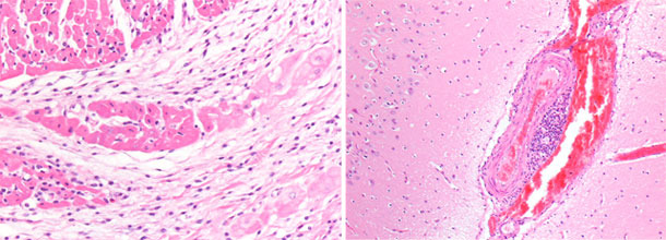 Congestione dei vasi venosi nell’emisfero cerebrale destro. Miocardio ventricolo dx.  necrosi focale basofila del miocardio con microvacuolizzazione del sistema di conduzione