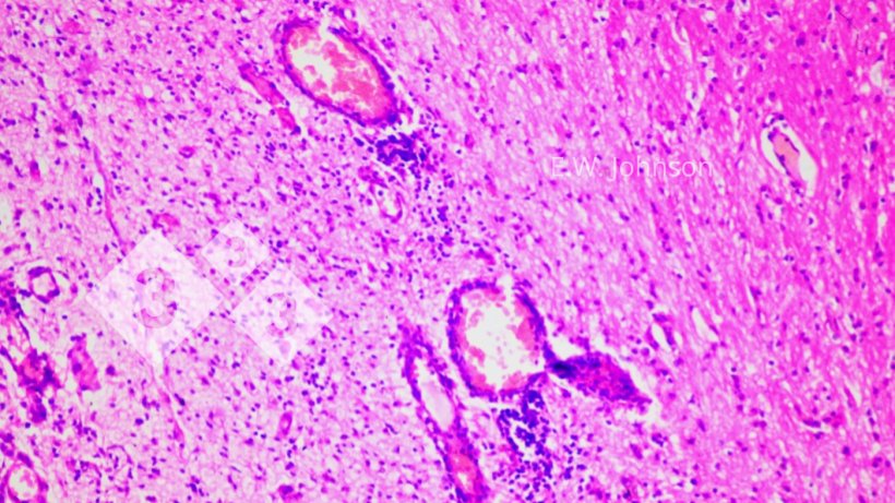Imagen 2. Manguitos perivasculares y gliosis. Cerebro.
