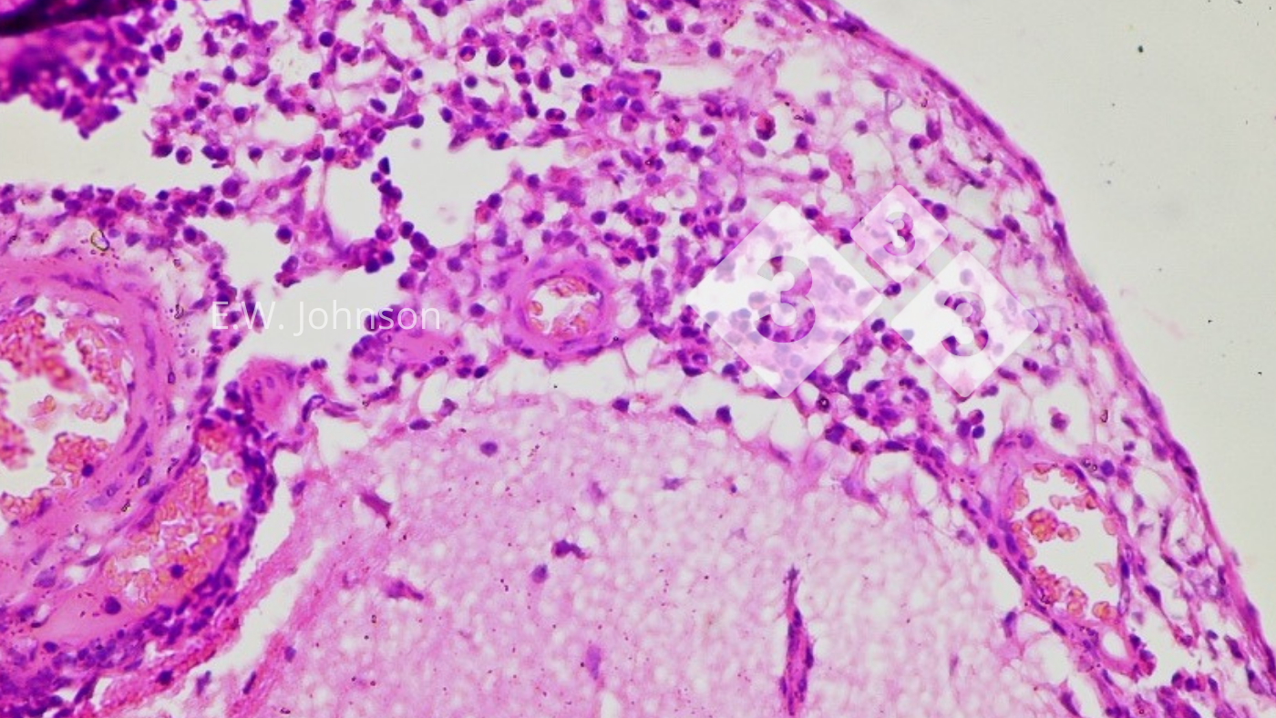 <p>Imagen&nbsp;3. Meningitis con c&eacute;lulas mononucleares y algunas c&eacute;lulas polimorfonucleares. Cerebro.</p>
