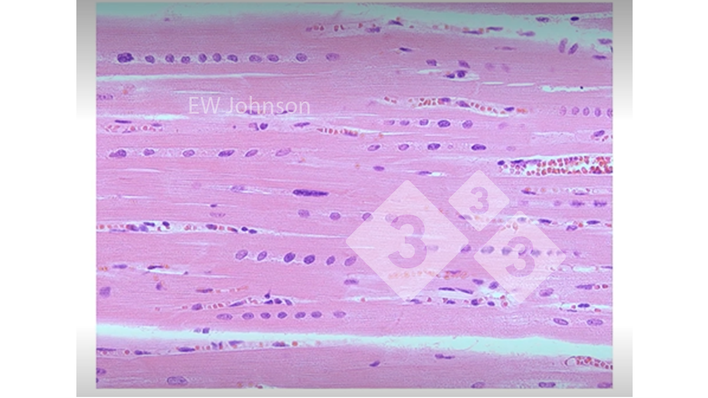 <p>Figura 3. M&uacute;sculo card&iacute;aco con hemorragia, necrosis hialina y alineamiento de los n&uacute;cleos que muestra deficiencia de vitamina E y selenio. Estos cerdos no tendr&iacute;an un sistema inmunol&oacute;gico que funcionara normalmente.</p>
