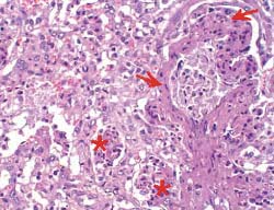 neumonía proliferativa necrotizante