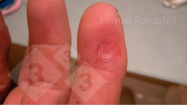 Los peque&ntilde;os y afilados colmillos de los lechones pueden producir estas molestas heridas en los dedos de los operarios durante el limado de dientes.
