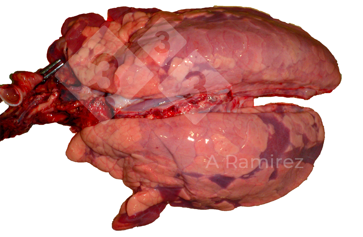 <p>Figura 3: Infecci&oacute;n por influenza A de presentaci&oacute;n irregular y difusa con ligero edema interlobular.</p>
