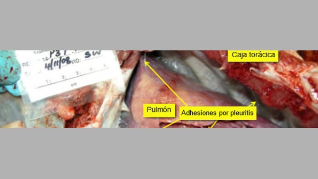 Pericarditis