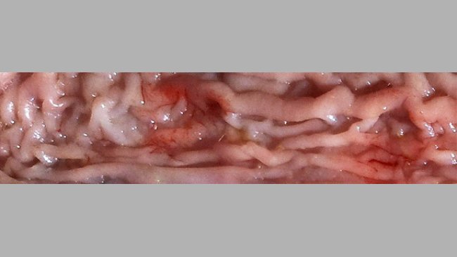 Engrosamiento de la mucosa en parte distal del intestino delgado